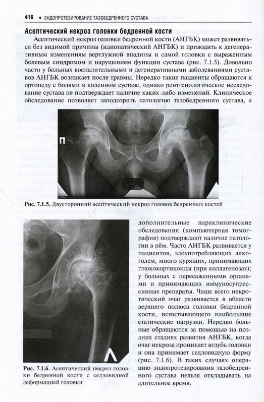 Асептический некроз головки бедренной кости сустава. Асептический некроз головки бедренной кости 2 степени. Асептический некроз головки бедренной кости рентген протокол. Асептический некроз тазобедренного сустава на кт.